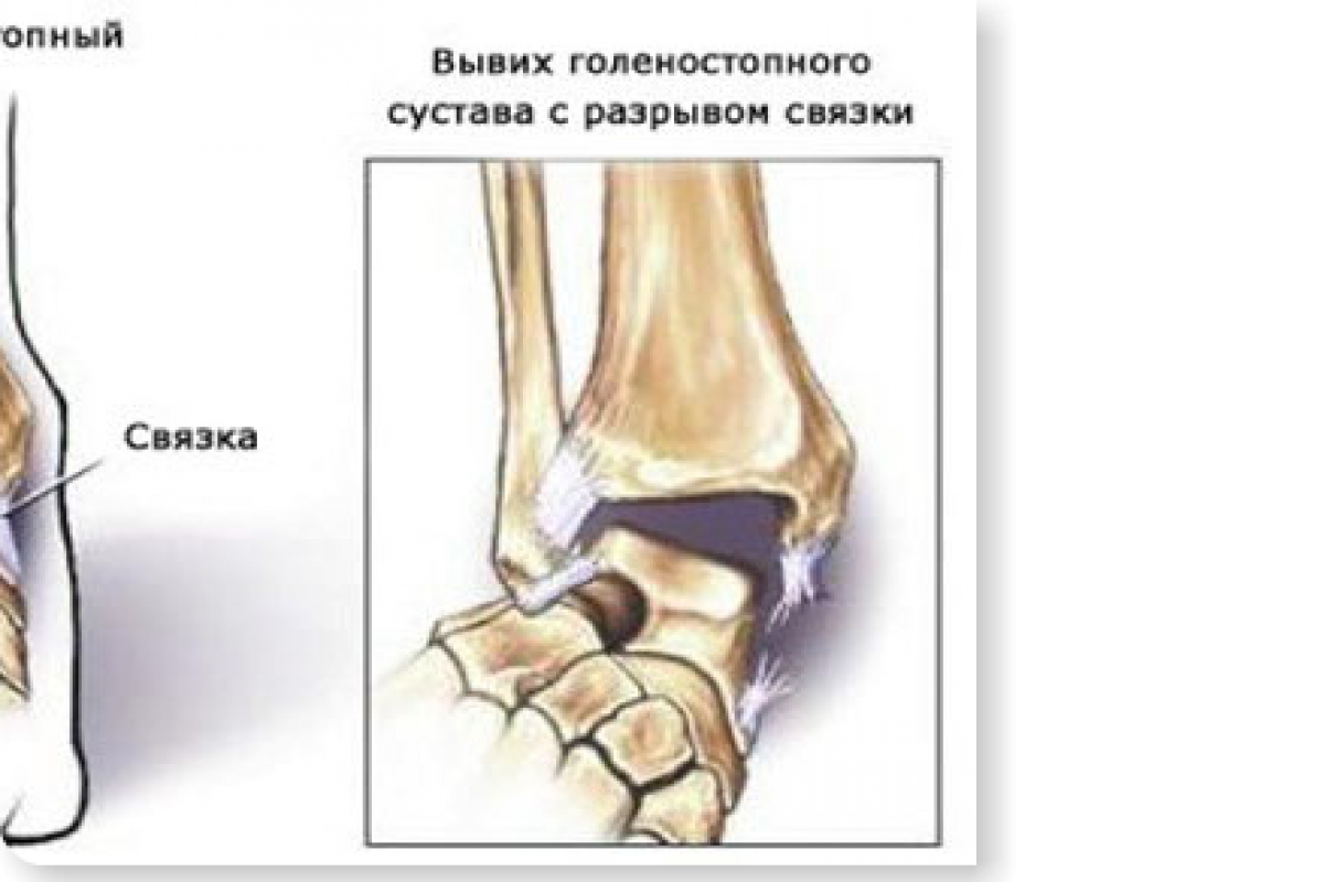 Лечение растяжения связок колена, симптомы, диагностика в Москве