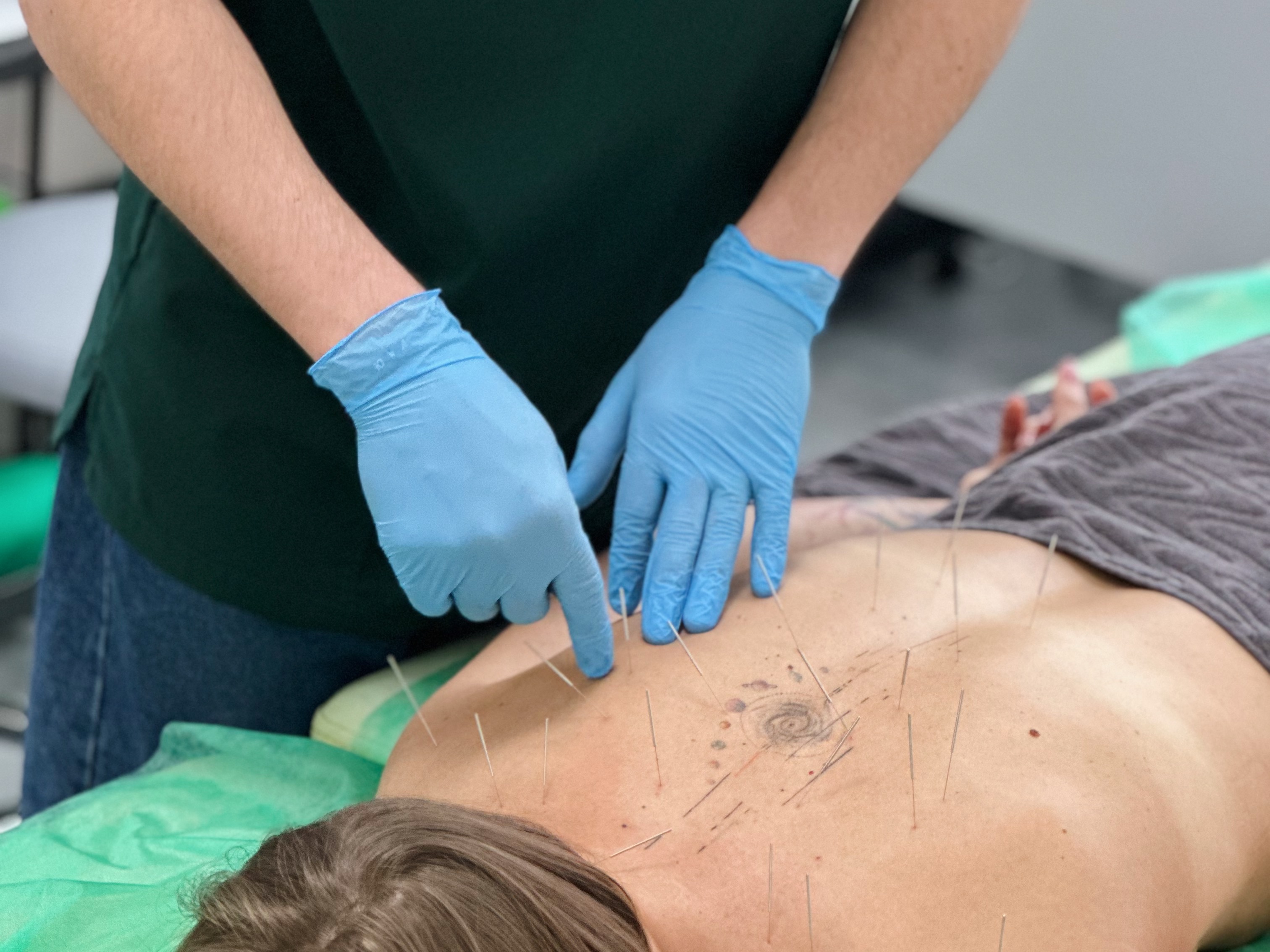 Рефлексотерапия