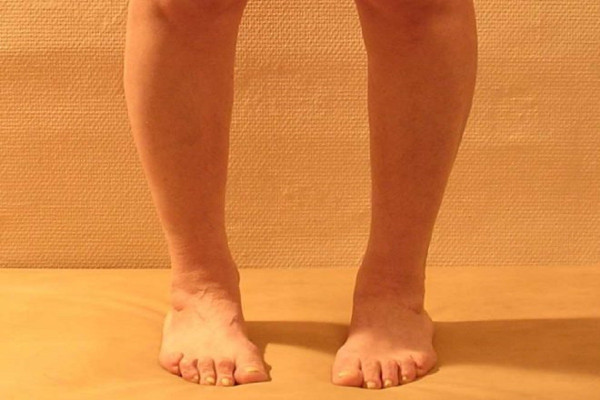 Косолапость