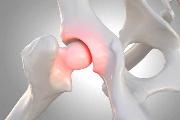 Бобат-терапия при дисплазии тазобедренных суставов