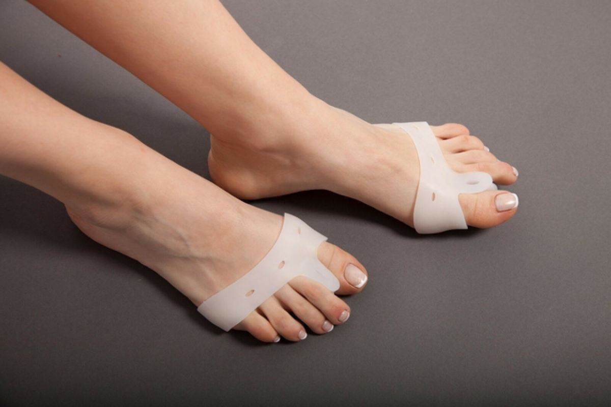 Вальгусная деформация первого пальца стопы