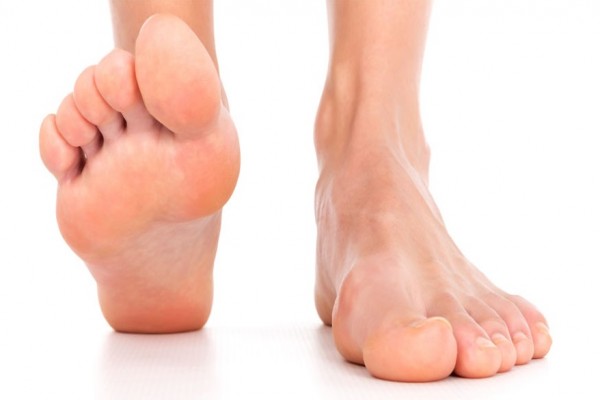 Плоскостопие