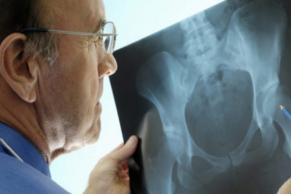 Ложный сустав (псевдоартроз)